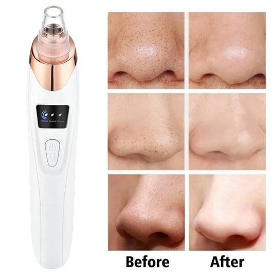 Electric Blackhead Remover Vacuum – Deep Pore Cleaner Machine